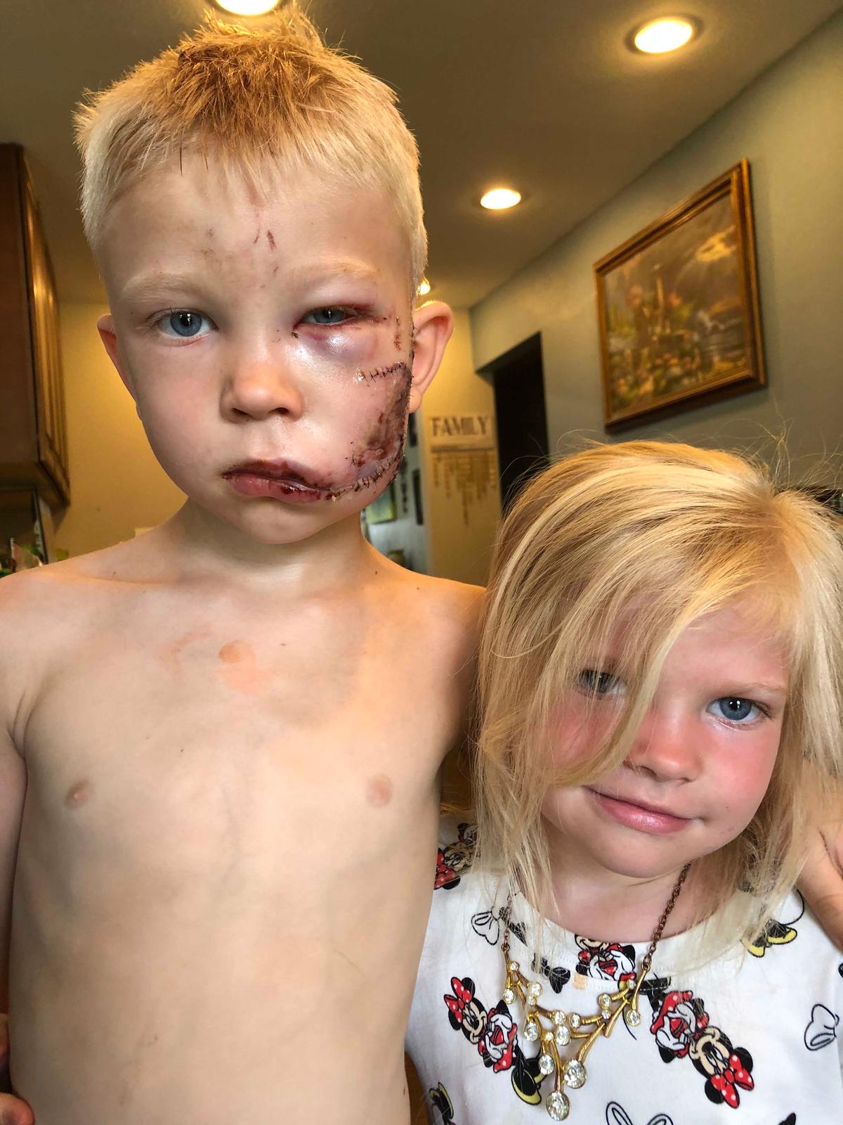 Bridger Walker with his sister after the attack (Caters News)