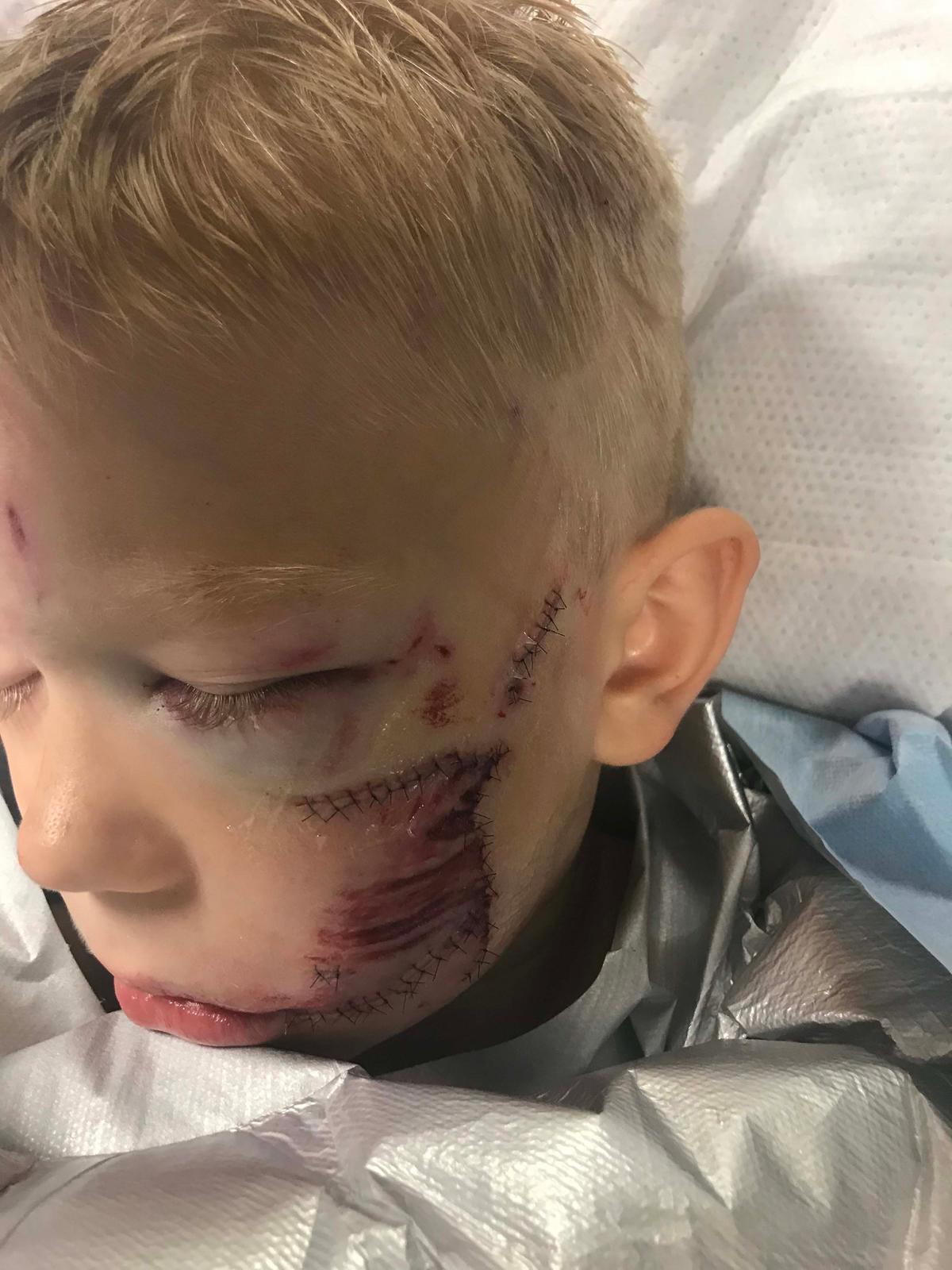 “I just finished visiting with Bridger at his home,” Bridger's aunt wrote on Instagram. “His wounds are looking so much better! He's in great spirits, and his awesome personality is intact." (Caters News)