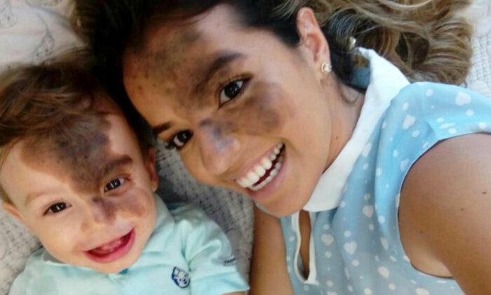 Mom Paints Her Face to Help Son With ‘Kiss of God’ Facial Birthmark Build Self-Confidence