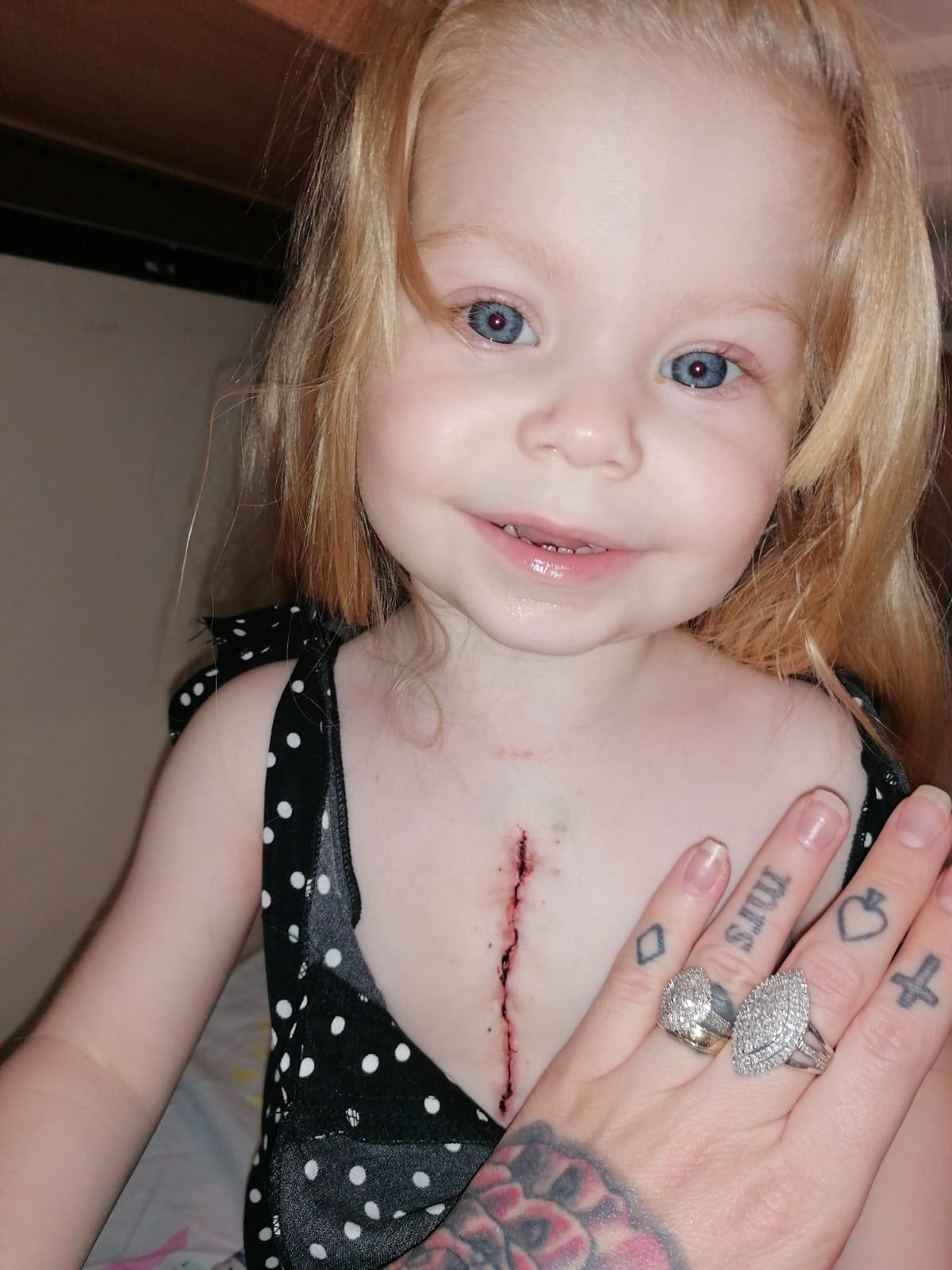 Lacey with a scar on her chest. (Caters News)