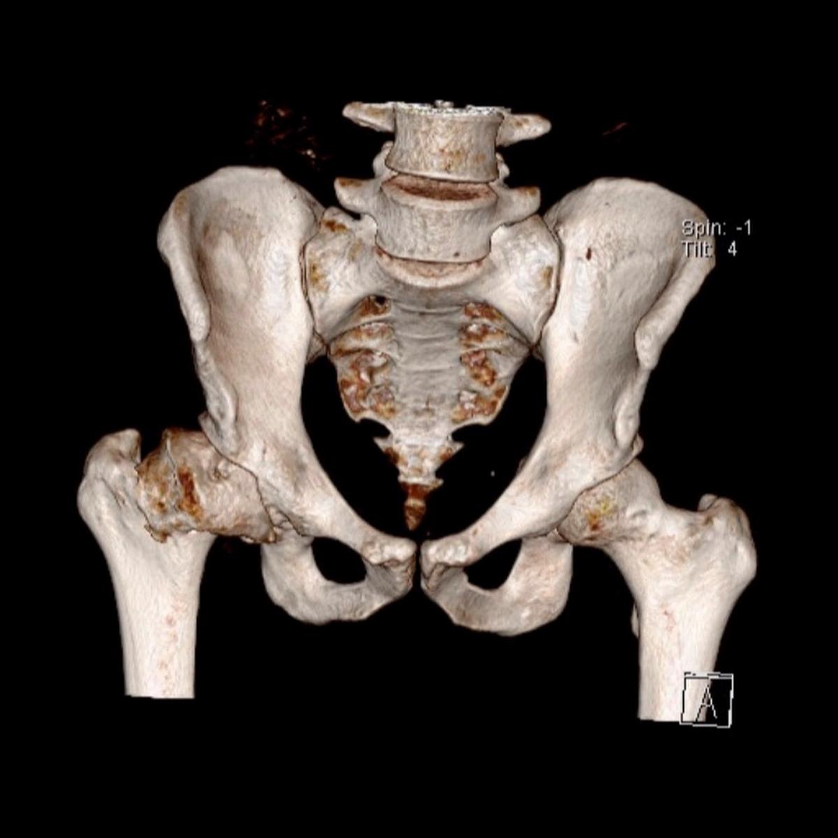 MRI scan shows Zachary Jones's left hip. (Caters News)