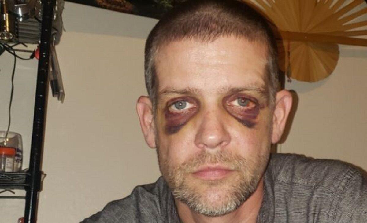 Adam Haner, who was assaulted in Portland, Ore., over the weekend, in a photograph taken on Aug. 20, 2020. (Adam Haner Fund/GoFundMe)