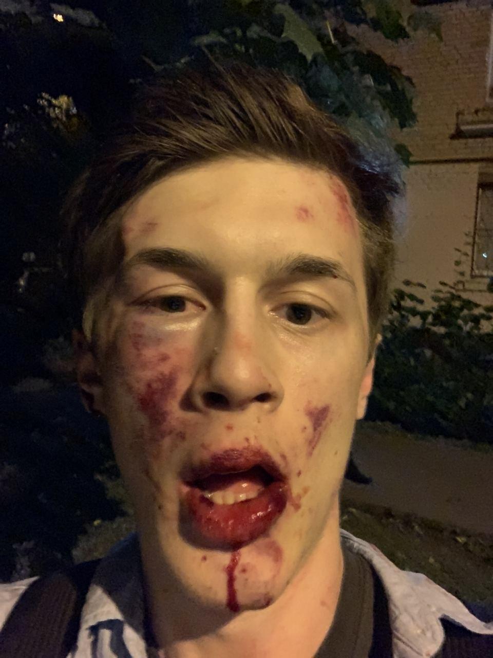 Opposition activist and political blogger Yegor Zhukov poses for a picture after he was assaulted by unknown people near his apartment in Moscow, on Aug. 30, 2020. (Zhukov's Team/Handout via Reuters)