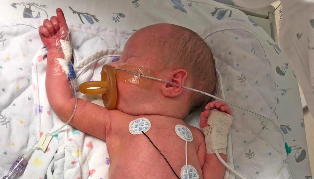 Baby Born With Small Intestines Outside His Tiny Body Has a Successful Surgery