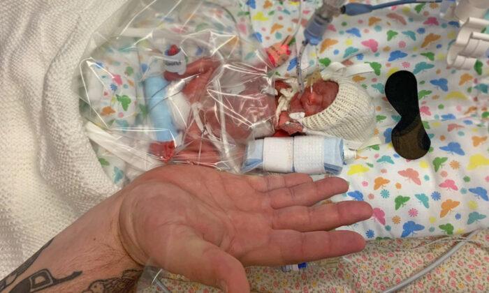 Baby Born Smaller Than Her Dad’s Hand and Given 10 Percent Chance of Survival Goes Home