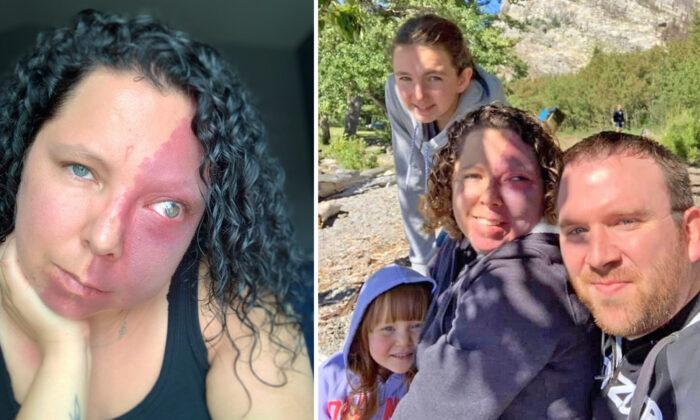 Mom Who Was Bullied for Facial Birthmark Thought She'd Never Find Love, Now Has a Dream Family