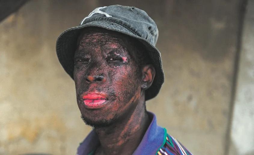 Zikhaya Sithole, 38, saved a baby's life while sustaining burn injuries on his face and hands. (Courtesy of <a href="https://www.instagram.com/rosettamsimango/">Rosetta Msimango</a>)