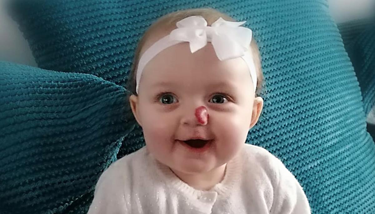 Parents Want Baby's Strawberry Birthmark Removed After Stranger Calls Her 'Rudolph'