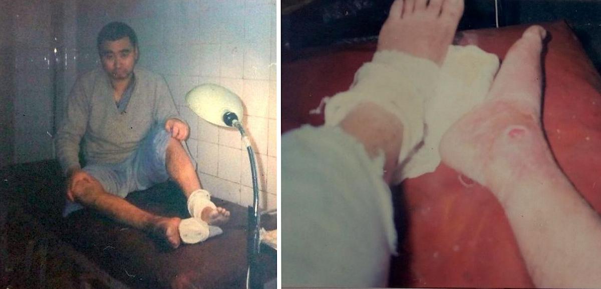 The pictures of Wei Chunyu with his injured right foot, taken 15 days after he sought treatment. (<a href="https://en.minghui.org/html/articles/2020/10/14/187806.html">Minghui</a>)