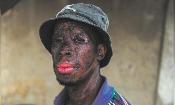 Man’s Face, Hands Scarred While Saving a Baby From a Burning Shack​