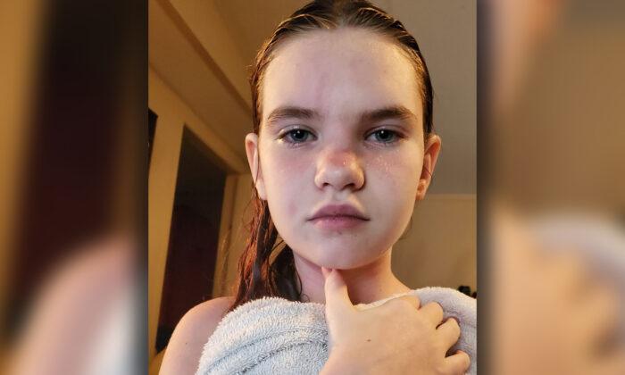 Schoolgirl’s Rare Water Allergy Is So Severe Even Showers Could Be Fatal
