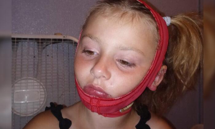 Girl’s Face Burned After Hand Sanitizer She Was Playing With Catches Fire