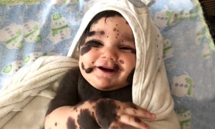 ‘Baby Boy Panda’: Parents Refuse to Give Up Newborn Son With 80 Percent Birthmarks