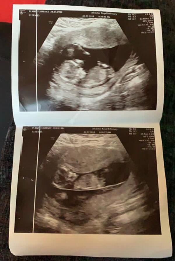 Photos of Florence's pregnancy scans. (Caters News)