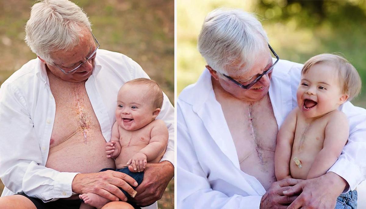 Grandpa and His Grandson With Down Syndrome Share 'Heartiversary' and Matching Scars