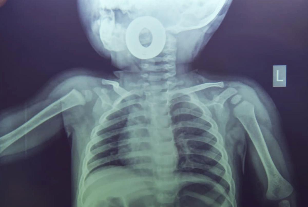 The X-ray of the baby revealing the bearing lodged in her throat. (Caters News)