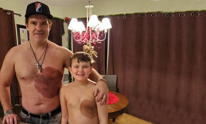 Dad Endures 30-Hour Tattoo, Surprises Son With Replica Birthmark to Boost His Confidence