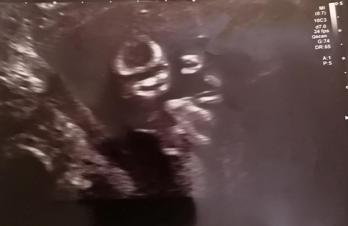 Baby Spicer appearing as if to wave "hi" during a scan (Caters News)