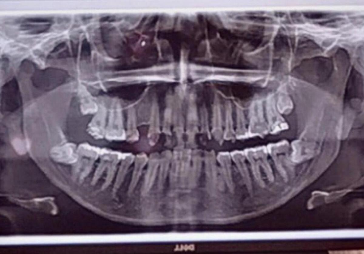 An X-ray showing the extent of Victoria's dental decay (Courtesy of <a href="https://www.facebook.com/victoria.nowakowskishaniqua">Victoria Irene Nowakowski</a>)