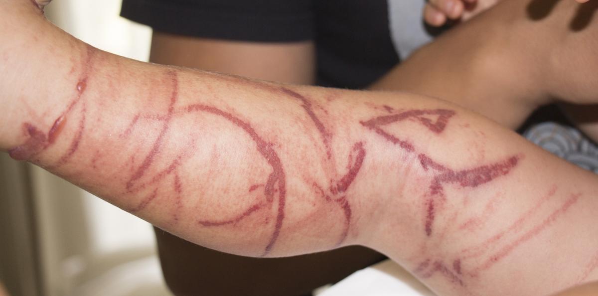 Box jellyfish lesions, caused by barbed tentacles, on a child's leg (DonyaHHI/Shutterstock)