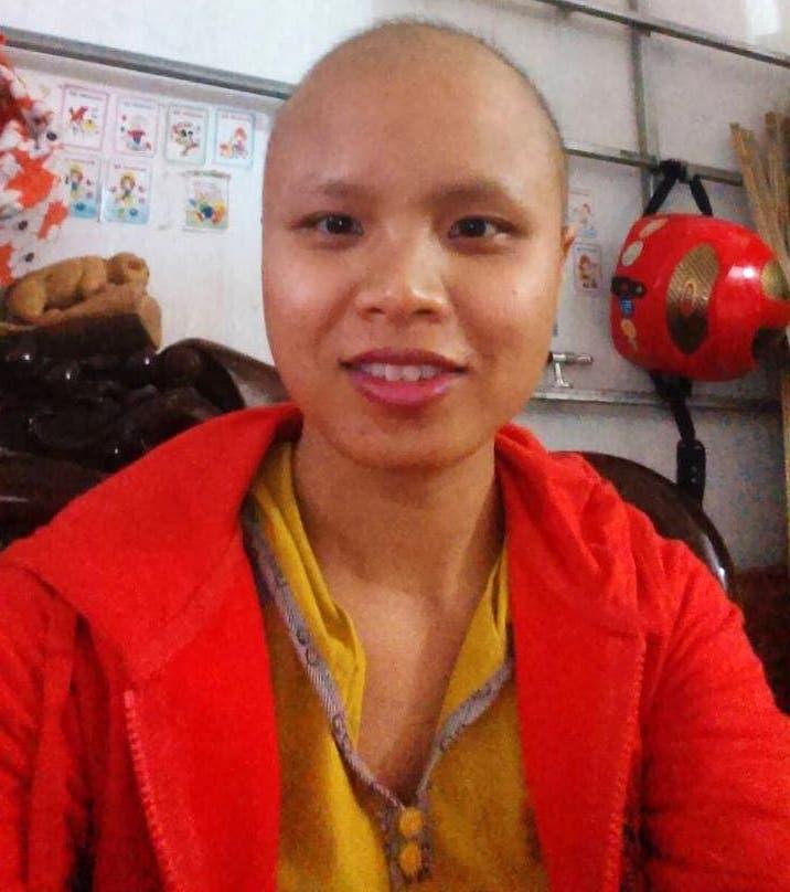 Hien lost all her hair while undergoing chemotherapy treatment in 2015. (Courtesy of Thu Hien Ta)