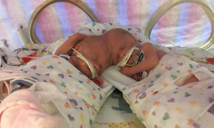 Twins Conjoined at Head Survived Separation, Are Now 4, Thriving, Prepping for Skull Reconstruction