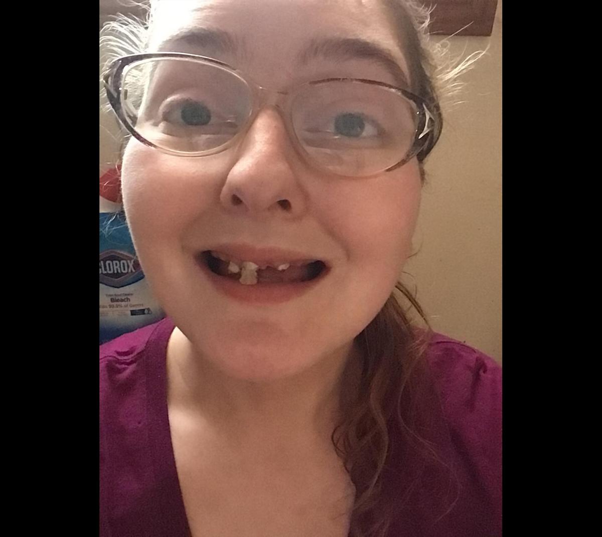 A photo taken around the time of Victoria's procedure, when her font incisor broke (Courtesy of <a href="https://www.facebook.com/victoria.nowakowskishaniqua">Victoria Irene Nowakowski</a>)
