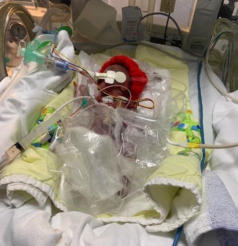 Baby Sydney in the hospital. (Courtesy of <a href="https://www.facebook.com/adam.hemmett">Adam Hemmett</a>)