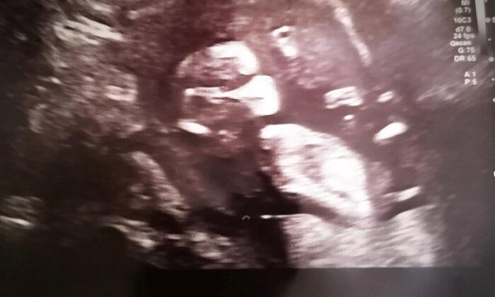 Pregnancy Scan Appears to Show Baby Wearing a Mask–as Mom Tests Positive for COVID