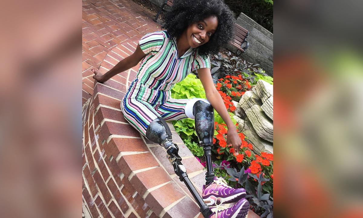 Quadruple Amputee Mom Becomes Model After Losing Limbs, Defying 1 Percent Odds of Survival