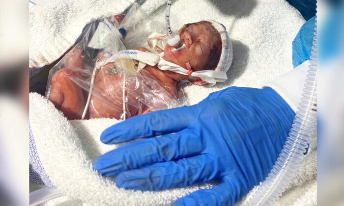One of Britain’s Most Premature Babies Born at Just 22 Weeks Defies Survival Odds
