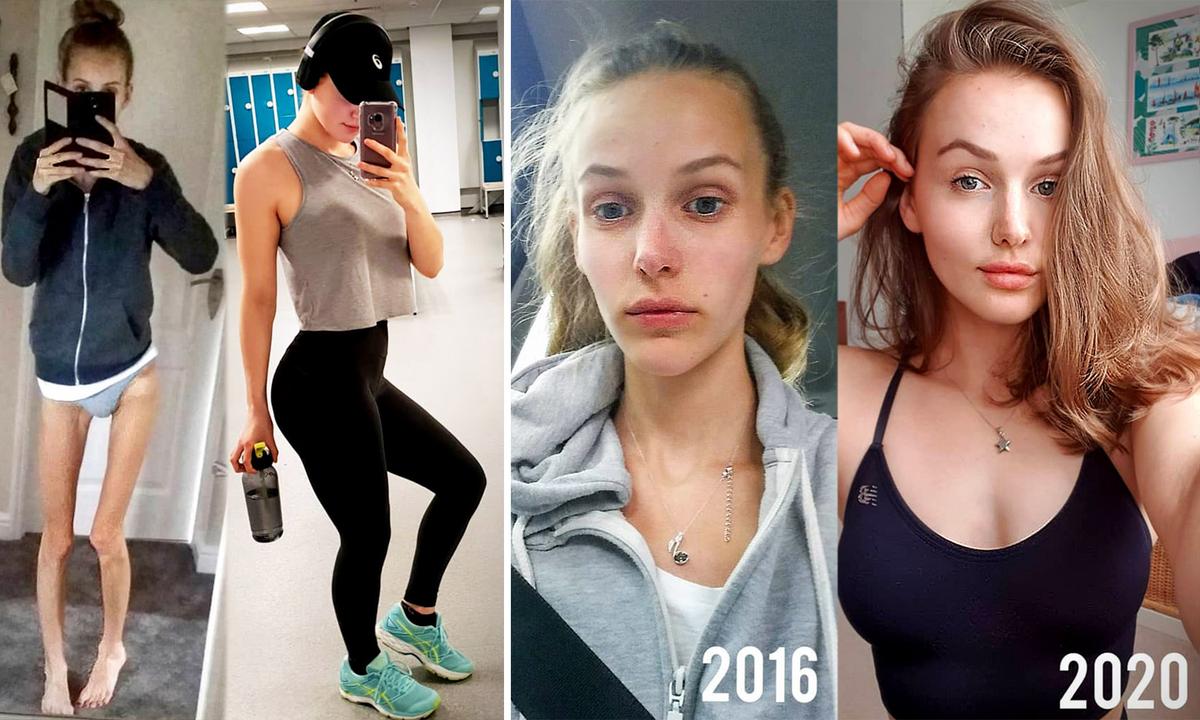 Anorexic Teen Was Rushed to Emergency–Became Fitness Guru After Making Incredible Recovery