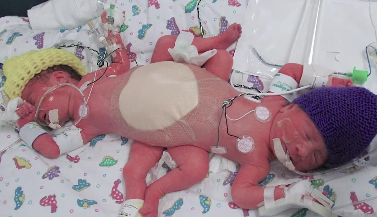 Conjoined Twins Scarlett and Ximena Torres. (Courtesy of <a href="https://www.driscollchildrens.org/">Driscoll Children’s Hospital</a>)