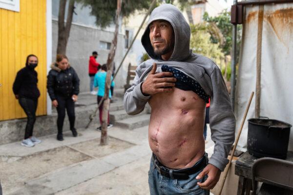 Jaime Vega displays gunshot wounds that he says were received from the crossfire of drug cartels, in Tijuana, Mexico, on April 22, 2021. (John Fredricks/The Epoch Times)