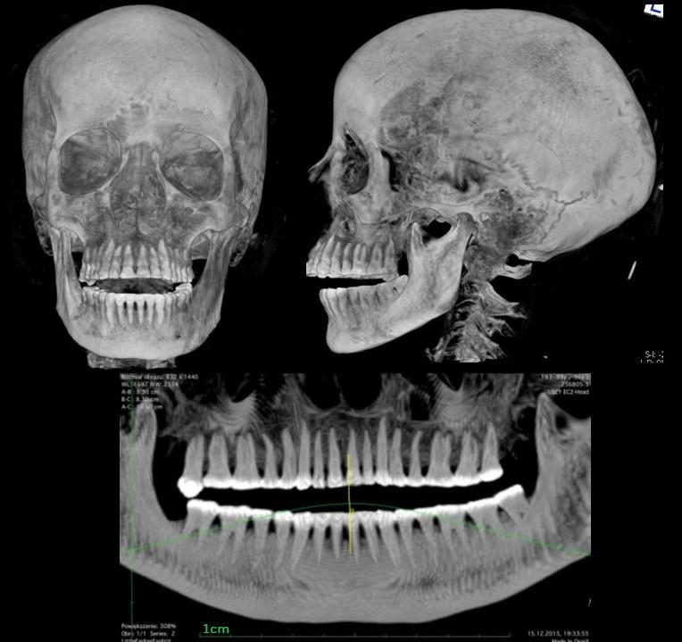 A scan showing the mummy's skull and teeth. (Courtesy of Marcin Jaworski/<a href="http://warsawmummyproject.com/en">Warsaw Mummy Project</a>)