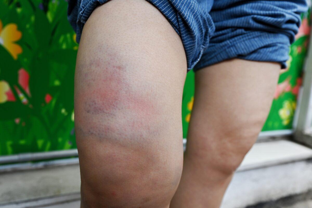 Sarah Liang, a reporter for the Hong Kong edition of The Epoch Times, shows her bruised legs outside of the Queen Elizabeth Hospital in Hong Kong on May 11, 2021. (Song Pi-lung/The Epoch Times)