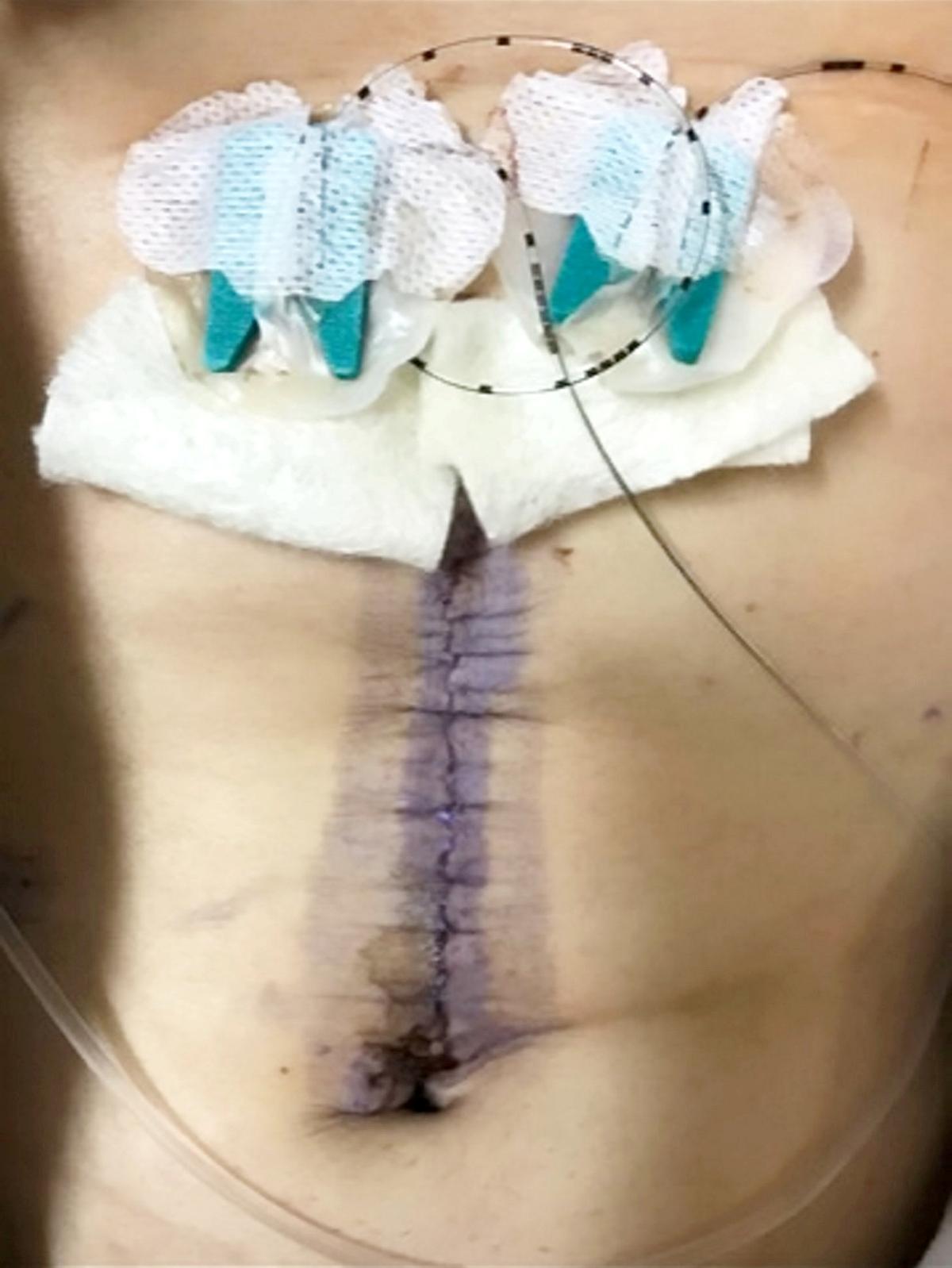 Sam's scar after the life-saving surgery. (SWNS)