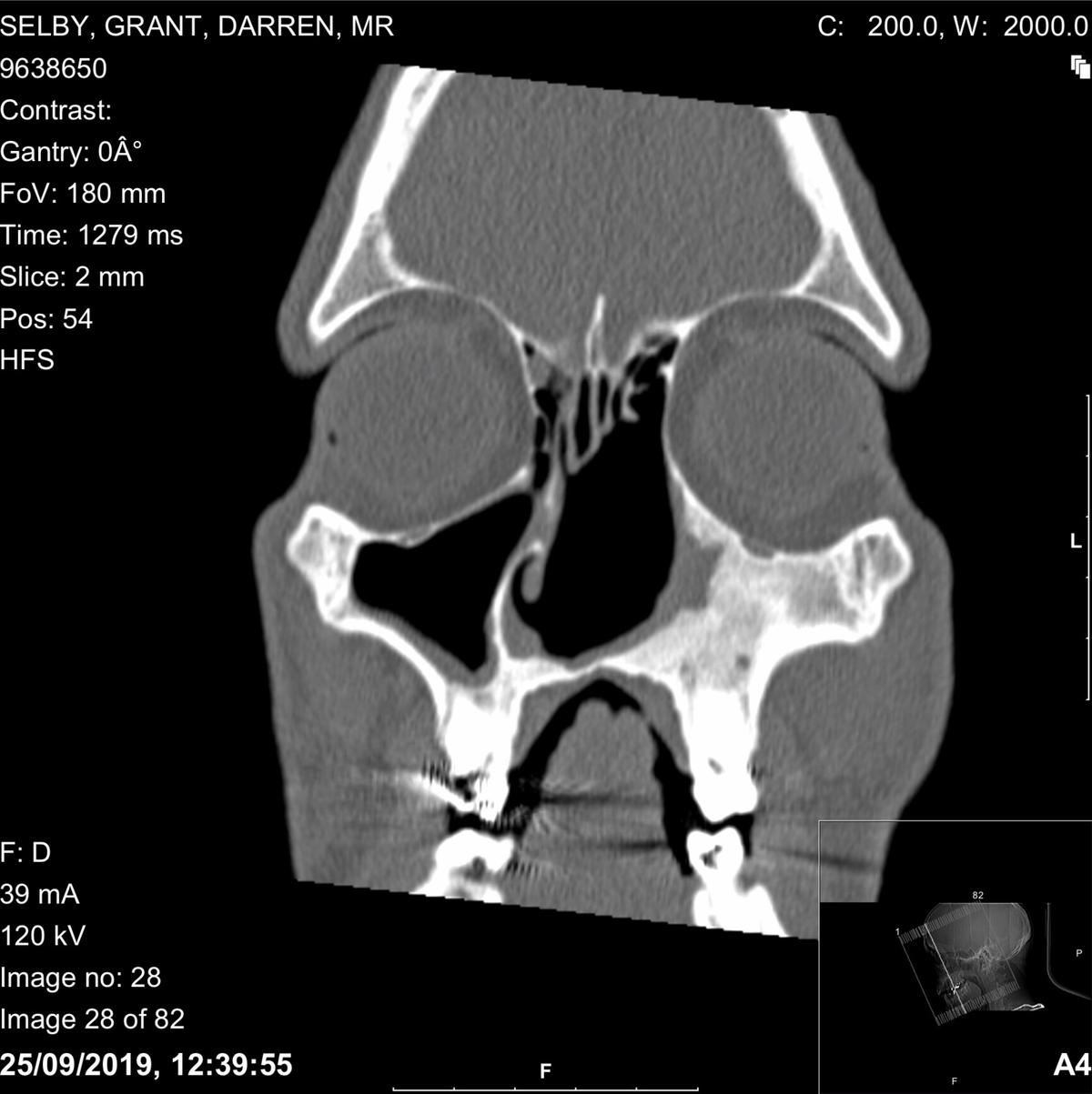An X-ray of Grant's septum damage. (Courtesy of Grant)