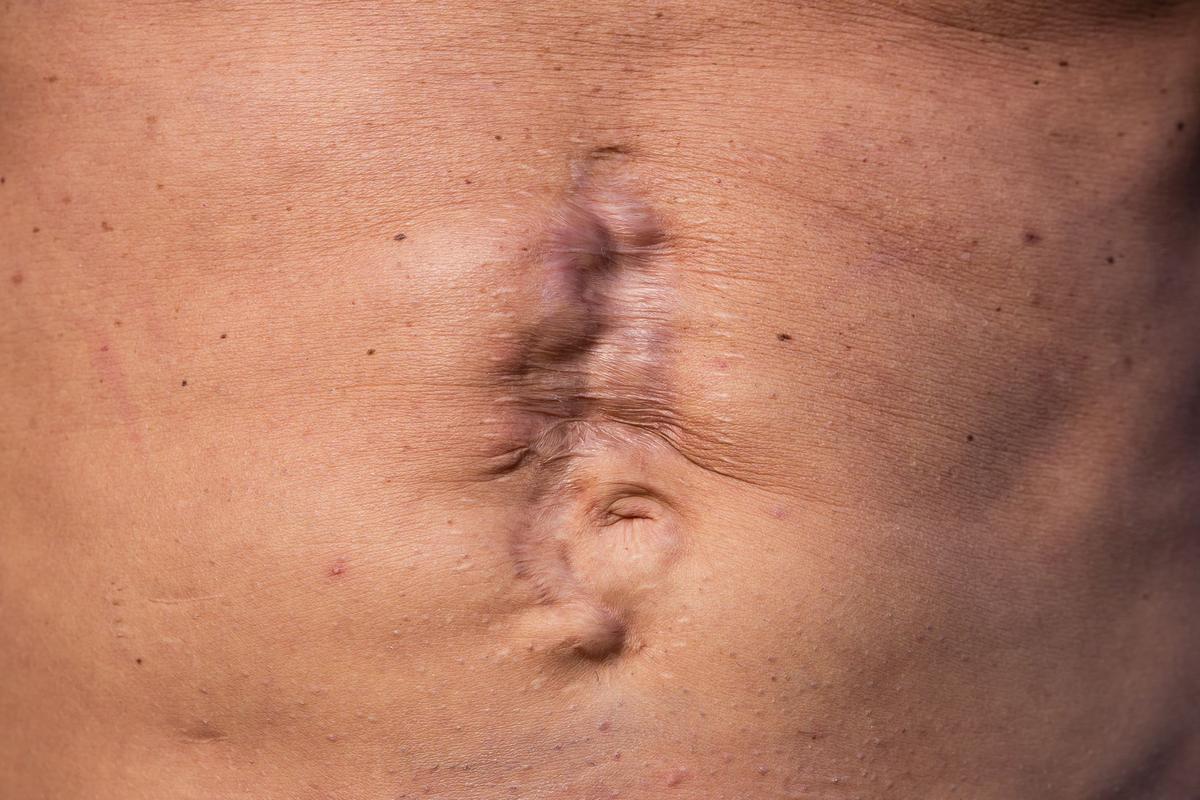 Grant's stomach ulcer, which eventually burst. (Courtesy of Grant/<a href="https://stepbysteprecovery.co.uk/">Step by Step Recovery</a>)