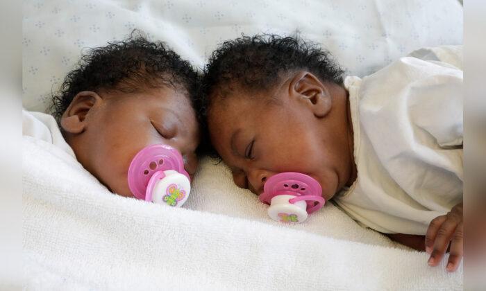 One in 2.5 Million Births: Twin Baby Girls Joined at the Head Are Successfully Separated