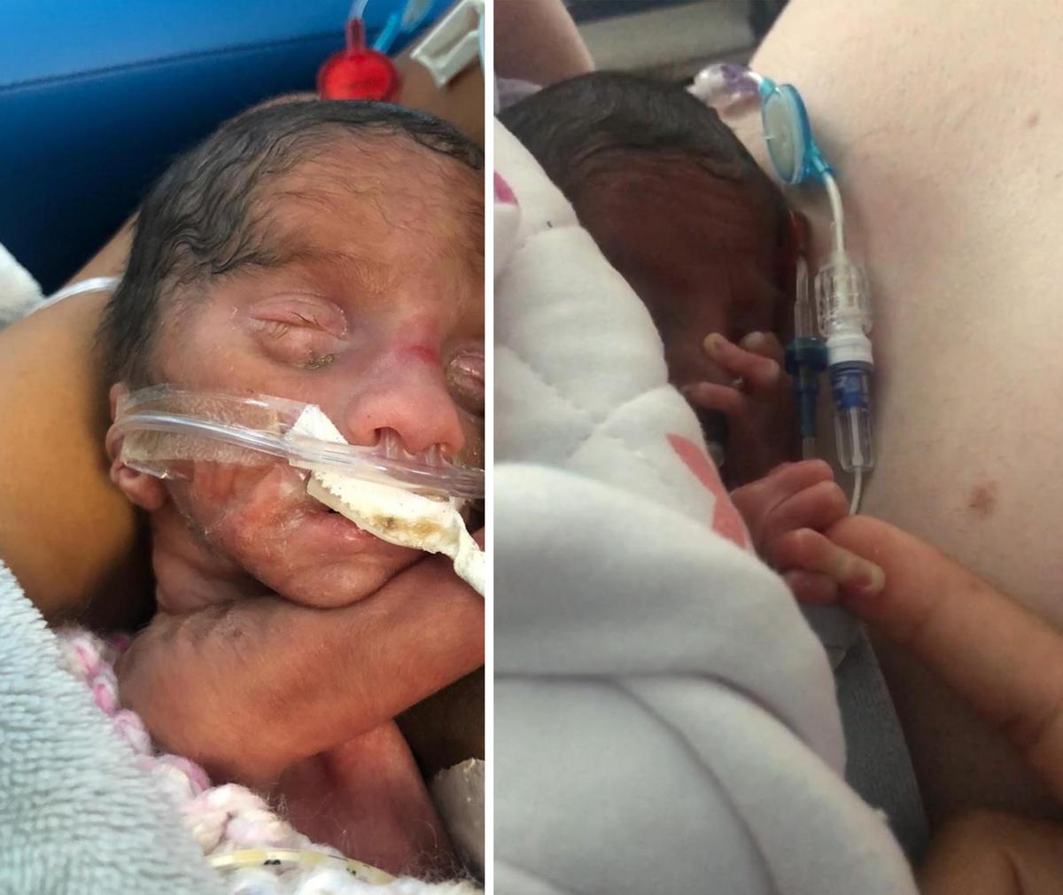 Preemie baby Arabella. (Courtesy of Caters News)