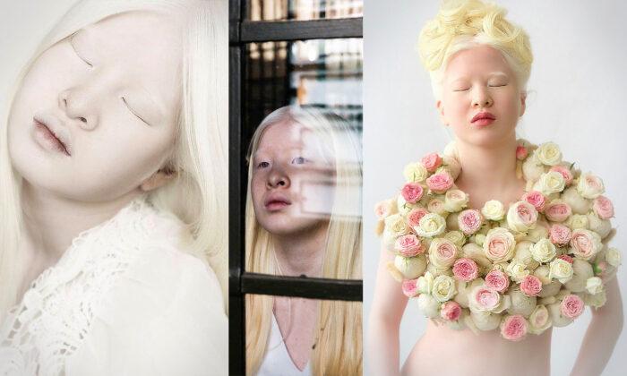 Albino Girl Abandoned by Parents in China Gets a New Life, Finds Success as a Teen Model