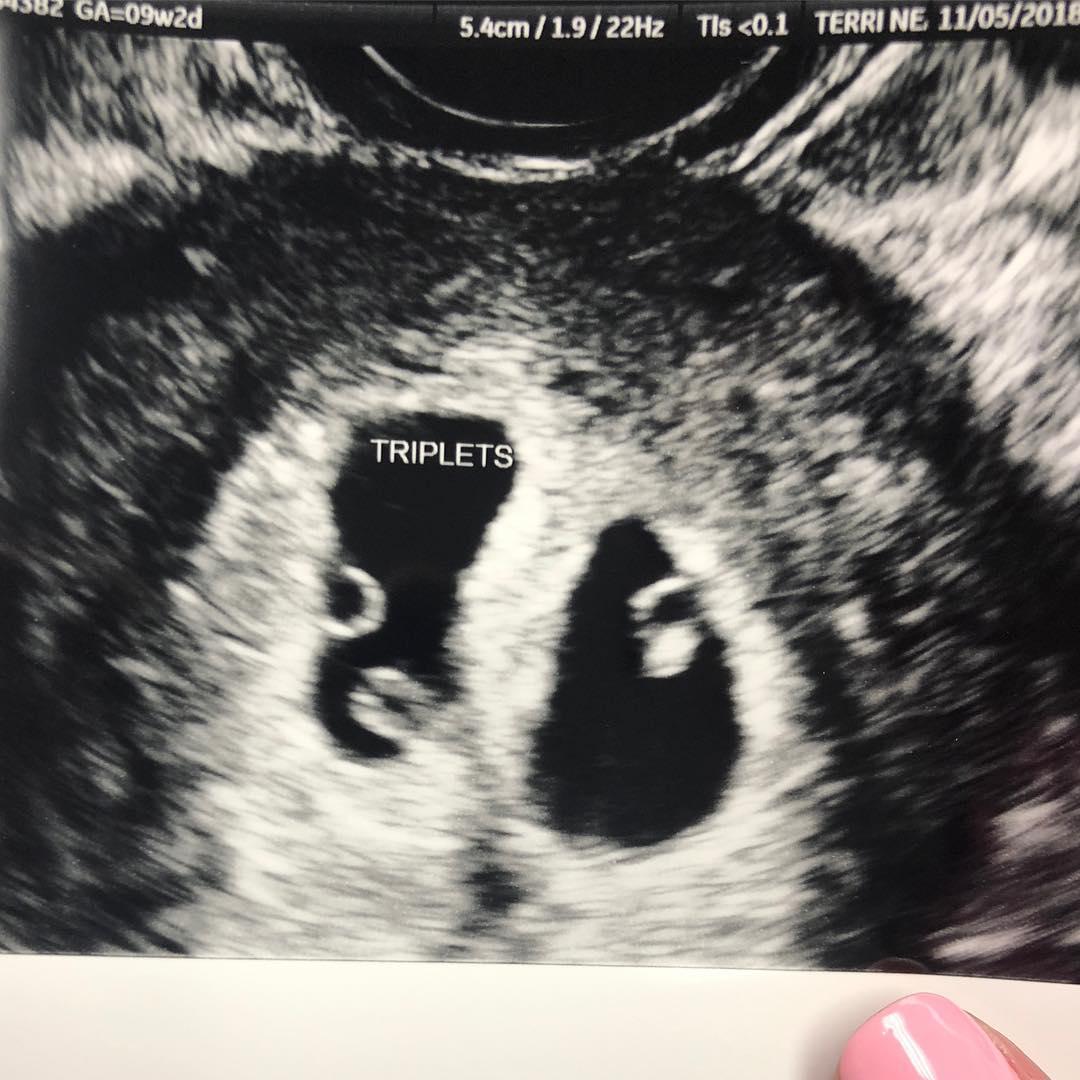 Christine's ultrasound scan showing triplets. (Courtesy of <a href="https://www.instagram.com/the_taala_girls/">Christine Taala</a>)