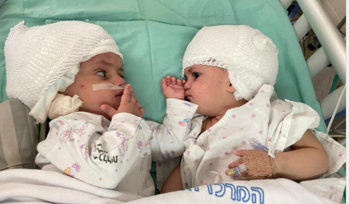 1-Year-Old Conjoined Twins Separated in Israel