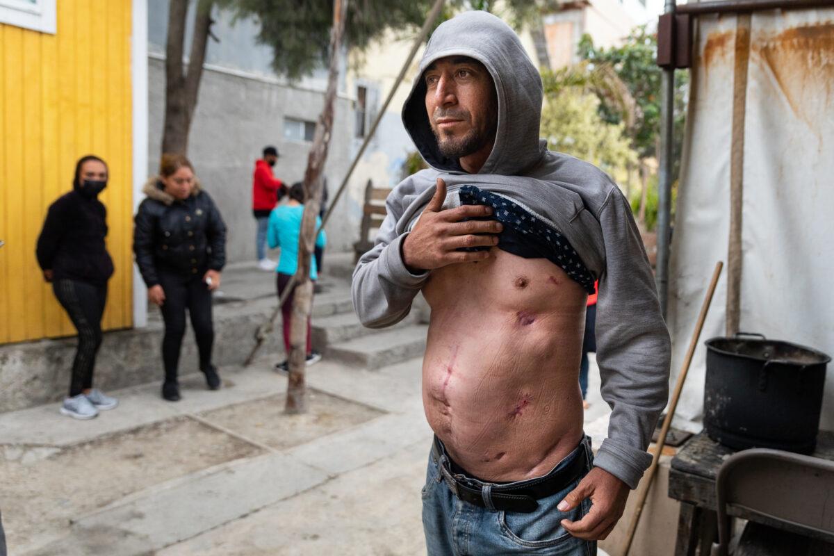 Jaime Vega displays his gun shots woumnds he recieved while in the crossfire of drug cartels in Tijuana, Mex., on April 22, 2021. He and his family eventually relocated to the United States under humanitarian grounds. (John Fredricks/The Epoch Times)