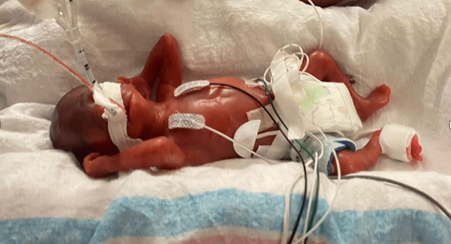 Curtis weighed 420 grams (0.9 lb) when he was born. (Courtesy of <a href="https://www.uab.edu/home/">UAB</a>)