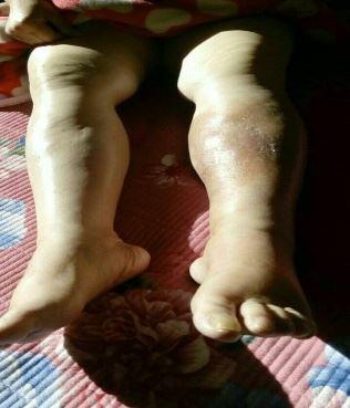 The swollen legs of Kang Aifen, during her latest incarceration. (File photo/Minghui.org)