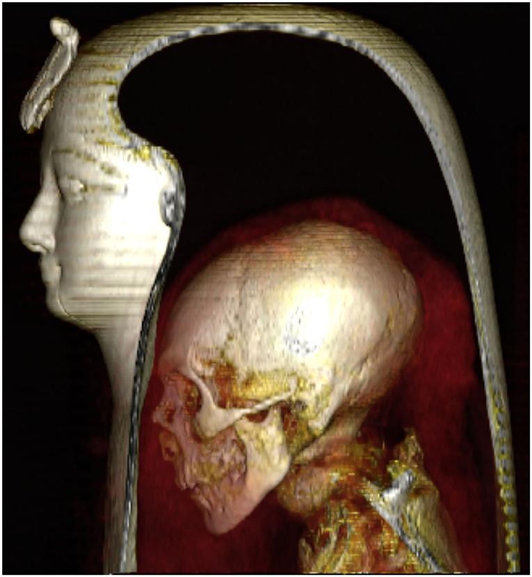 Three-dimensional CT image of the head of the wrapped mummy of Amenhotep I. (Courtesy of Sahar N. Saleem & Zahi Hawass)