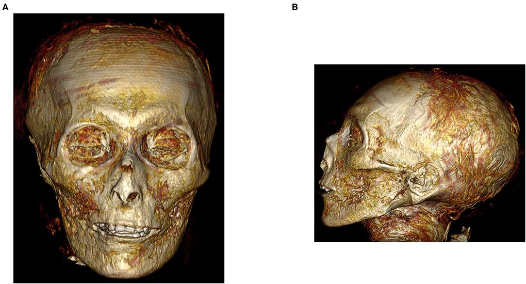 Three-dimensional CT image of the digitally unwrapped face of the mummy Amenhotep I. (Courtesy of Sahar N. Saleem & Zahi Hawass)