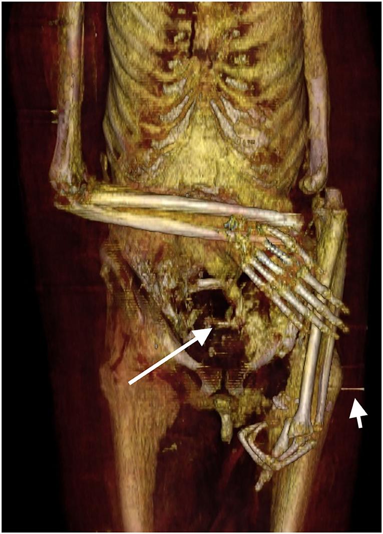 The right forearm is flexed at the elbow and crosses the lower abdomen transversely. The dislocated left arm and forearm are placed extended along the left side of the body. (Courtesy of Sahar N. Saleem & Zahi Hawass)